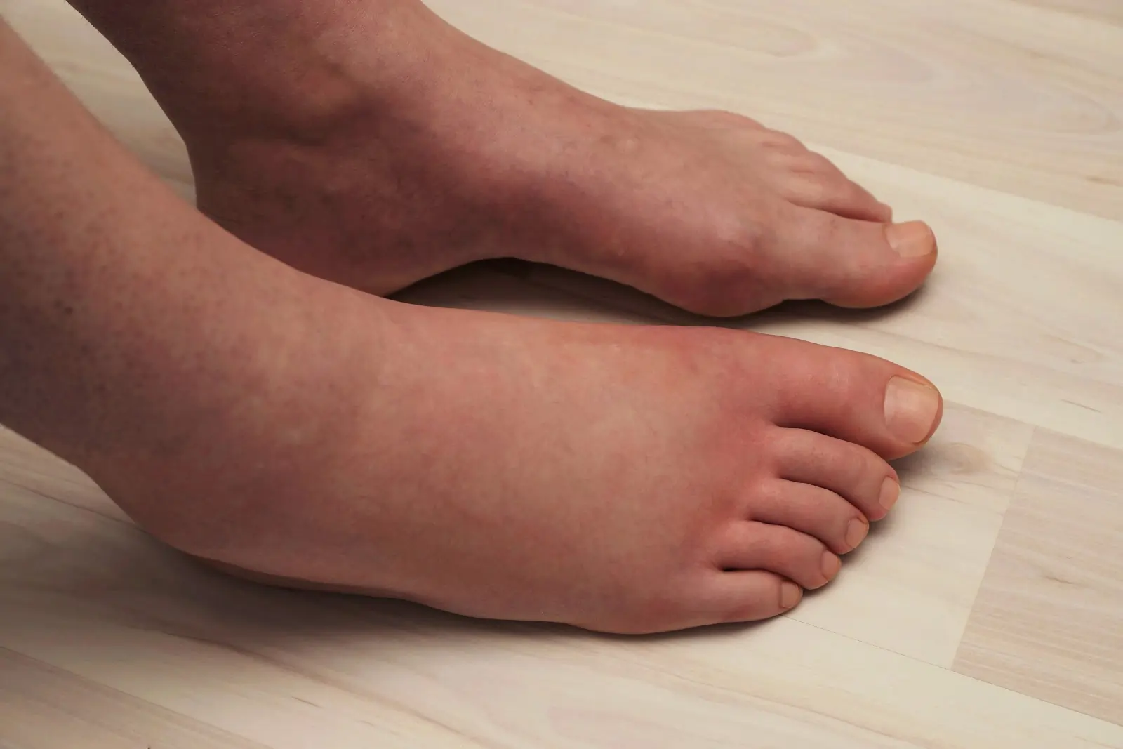 A pair of swollen feet on light, hardwood floors.
