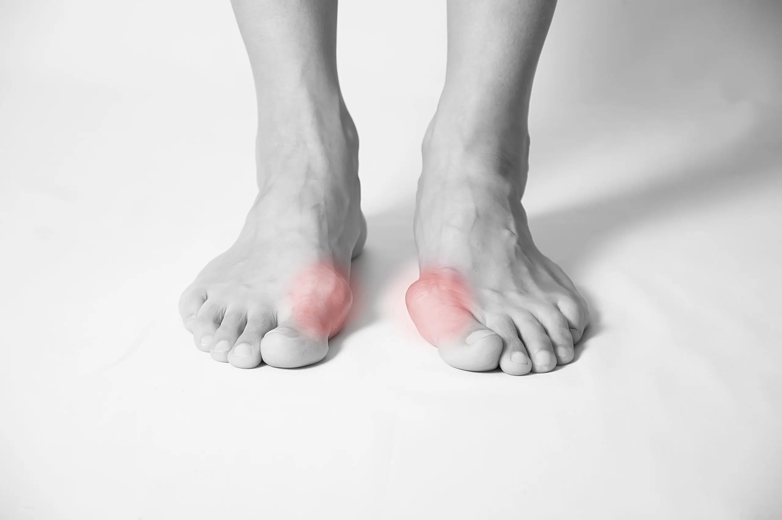 Black-and-white photo of ankles and feet with highlighted areas to signal bunion pain.