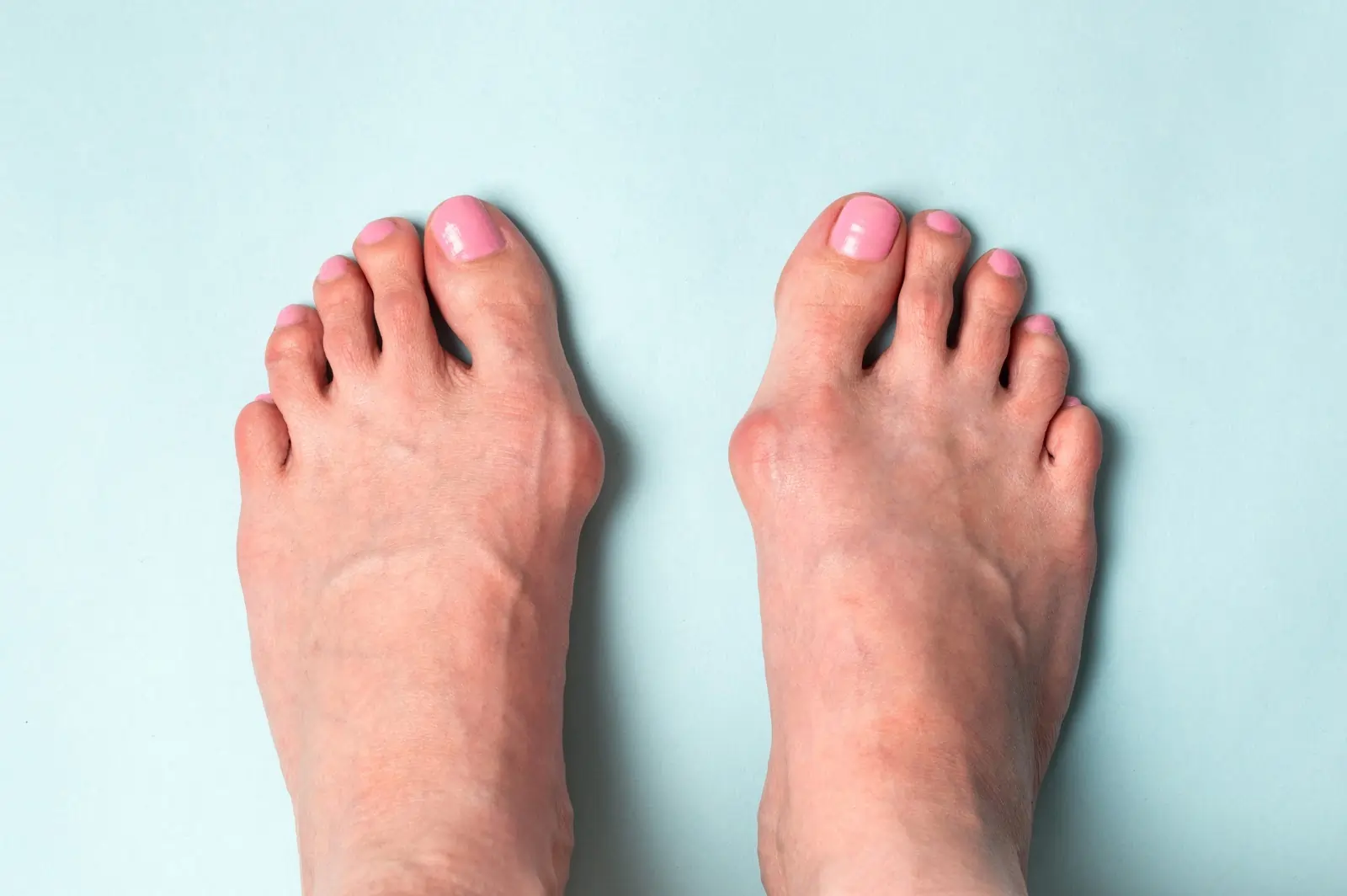 A pair of feet on a light blue surface, both with bunions.