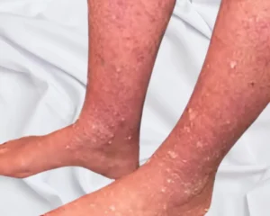 July 2025 Blog Actinic Keratosis KC Foot Specialists Overland Park