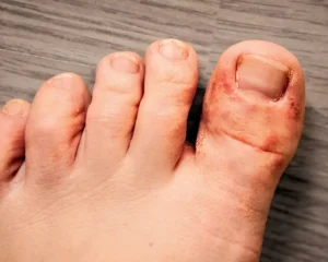 July 2025 Blog Athlete's Foot KC Foot Specialists Overland Park