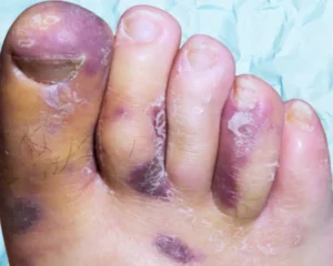 July 2025 Blog Kaposi's Sarcoma KC Foot Specialists Overland Park
