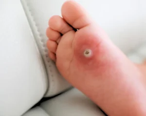 July 2025 Blog Plantar Wart KC Foot Specialist Overland Park