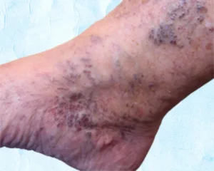 July 2025 Blog Venous Stasis Dermatitis KC Foot Specialists Overland Park
