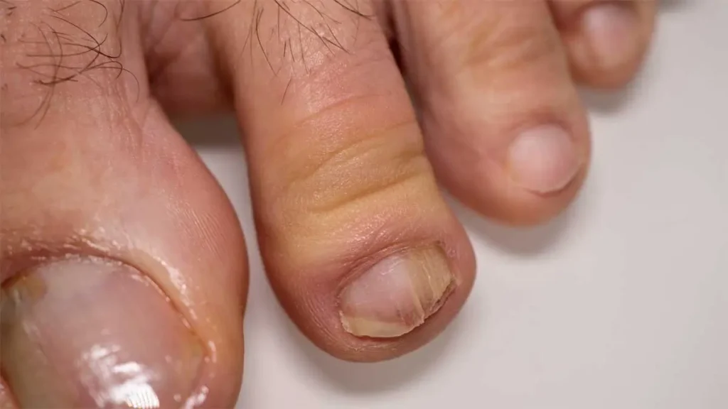 nail and foot fungus KC Foot Specialists Overland Park